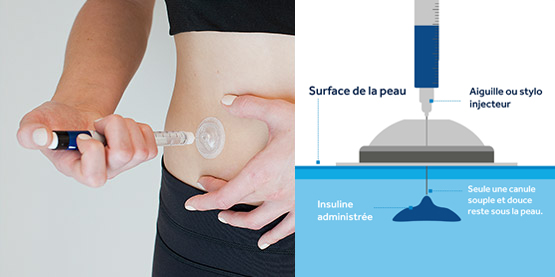 i-Port Advance™
