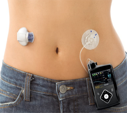 Continuous Glucose Monitoring (CGM)