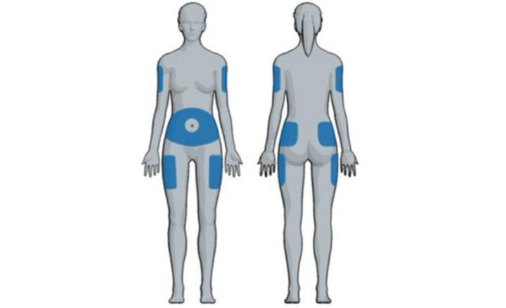 Lumps and bumps from insulin therapy