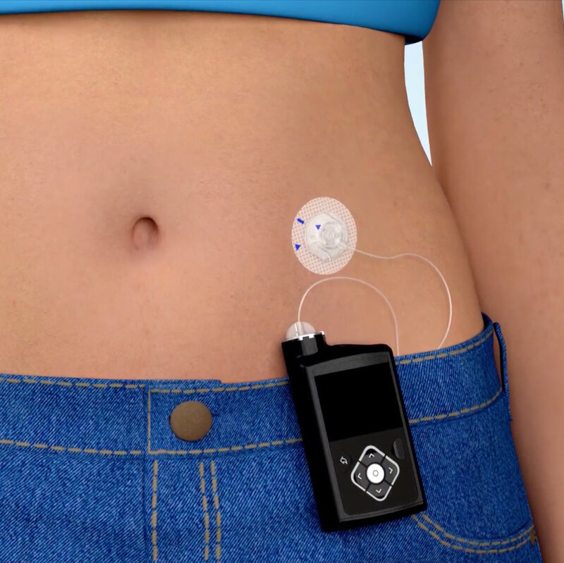 What is Insulin Pump Therapy
