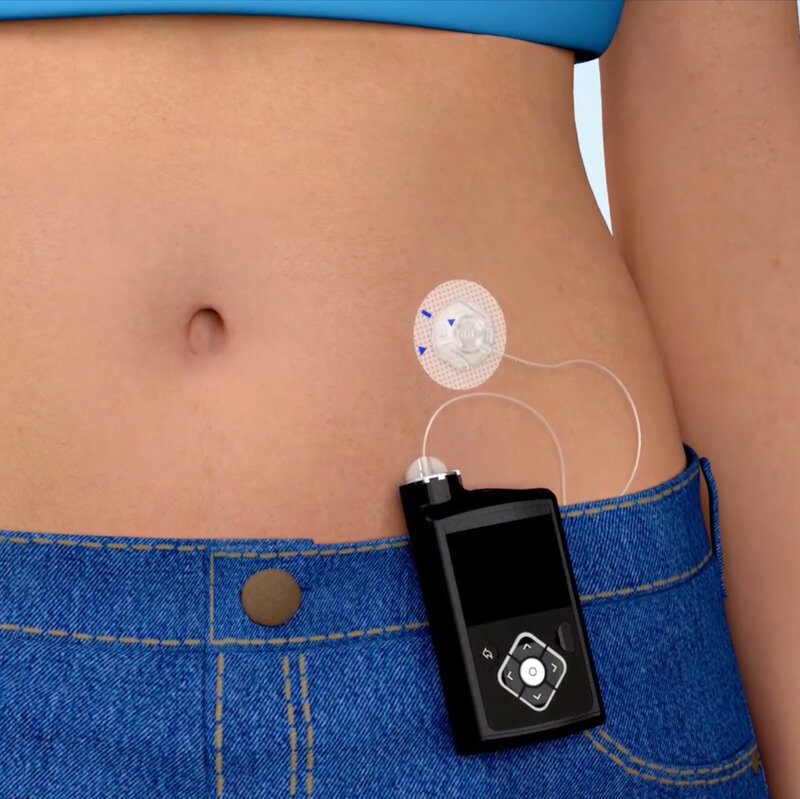 What is Insulin Pump Therapy