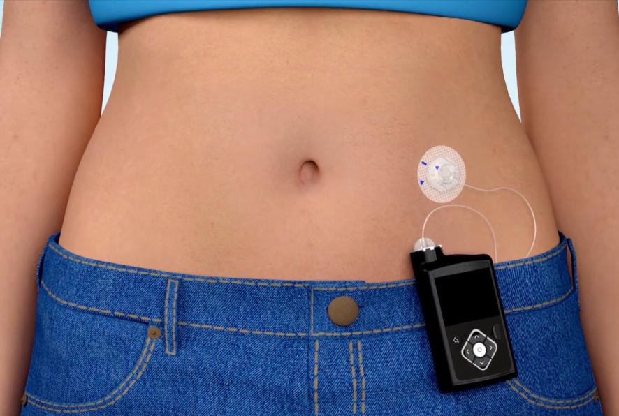 Tres Órgano digestivo recuperar Sistema de tratamiento con bomba de insulina | Medtronic Diabetes ES
